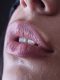Lip Filler Newcastle