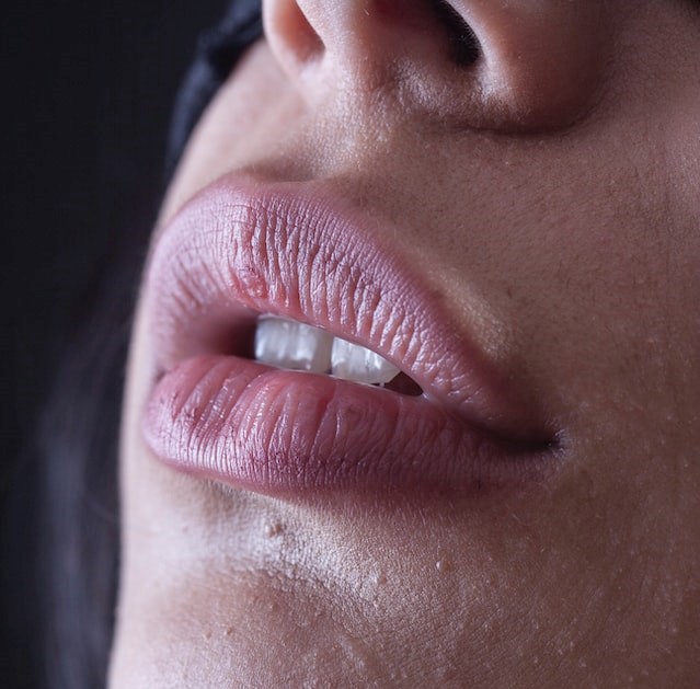 Lip Filler Newcastle