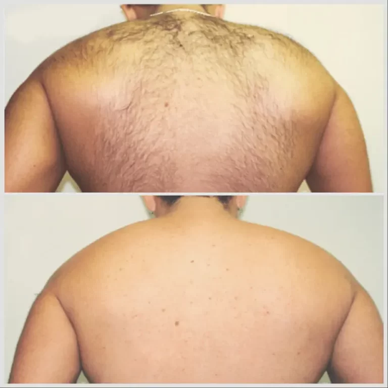 Laser Hair Removal