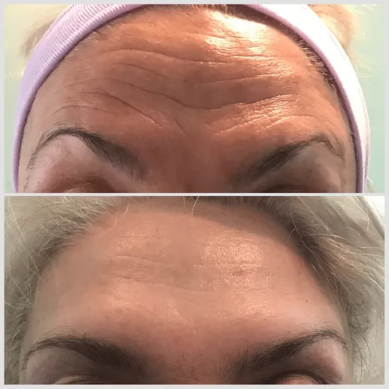 Anti Wrinkle Injections