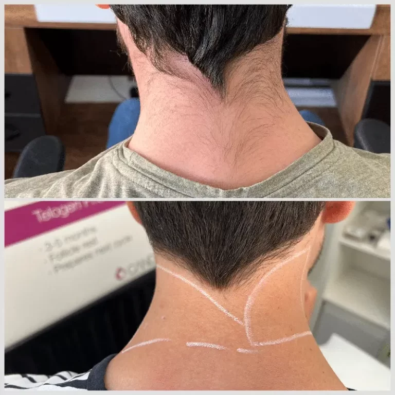 Laser Hair Removal