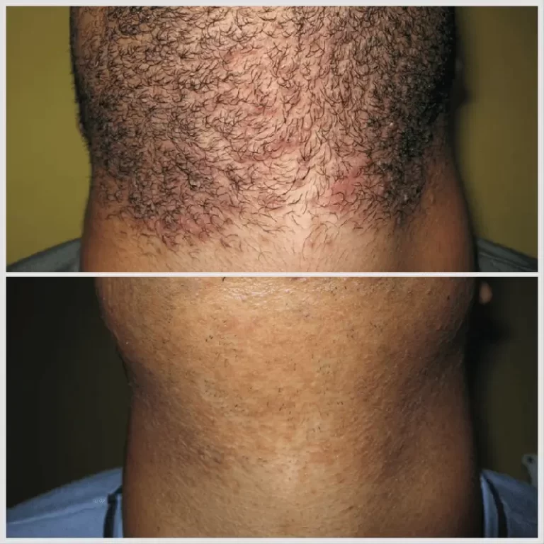 Laser Hair Removal