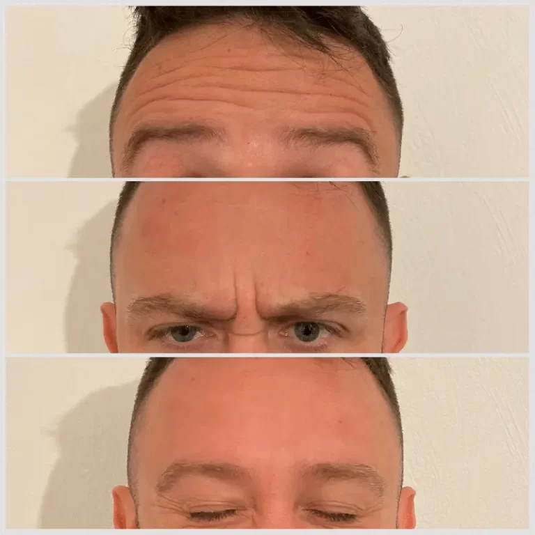 Anti Wrinkle Injections