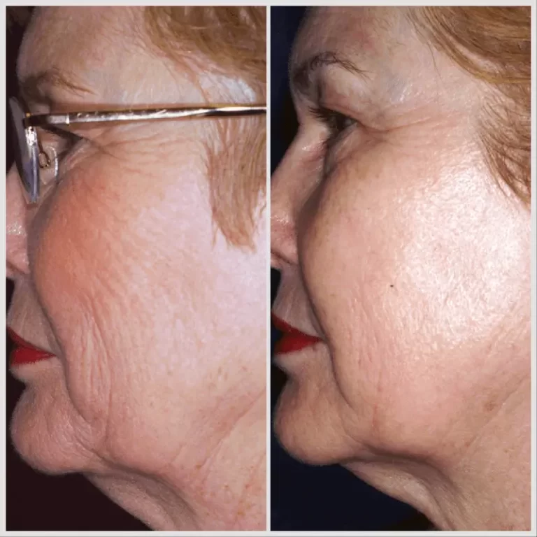 Skin Boosters