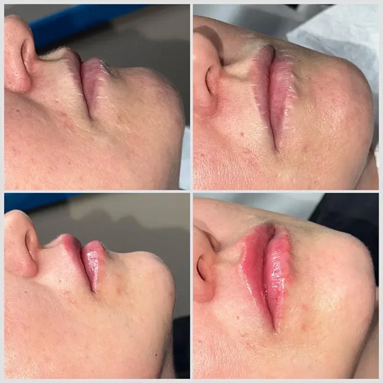 Lip Filler Treatment