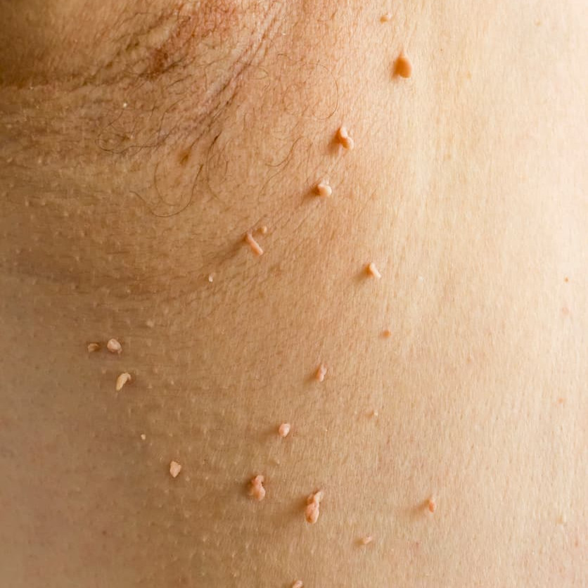 CryoPen skin lesion removal