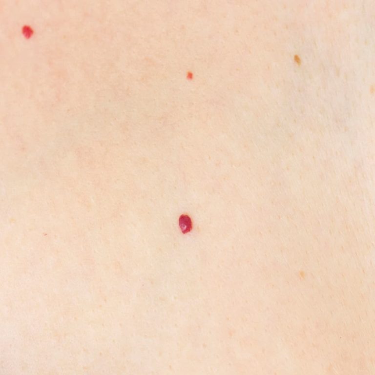 Cherry Angioma
