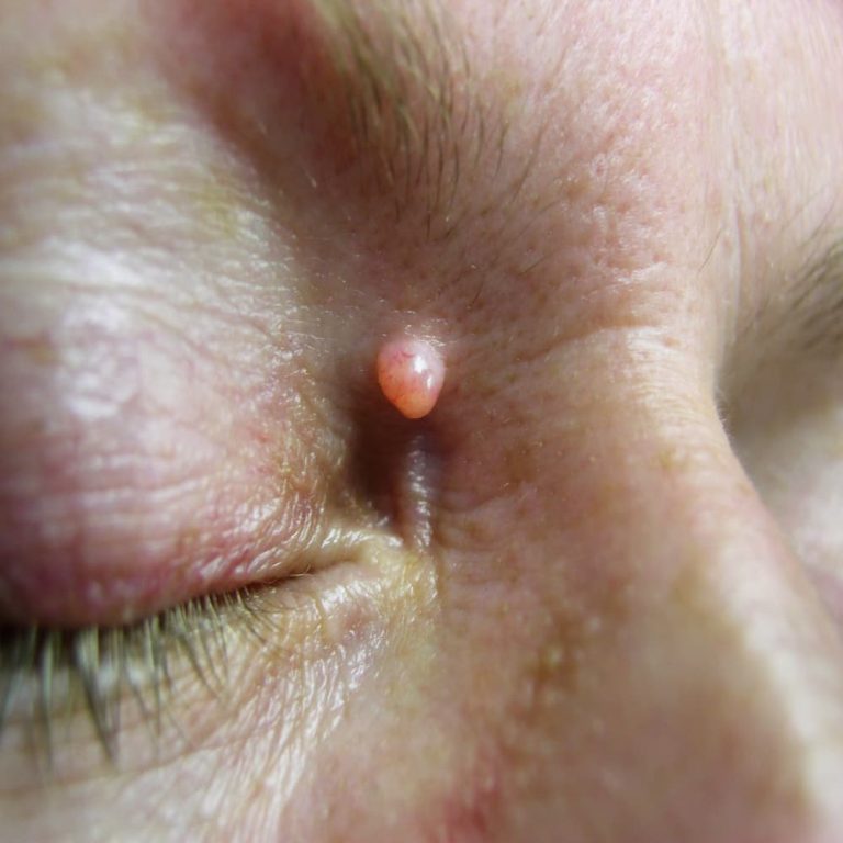 Angio & dermatofibroma