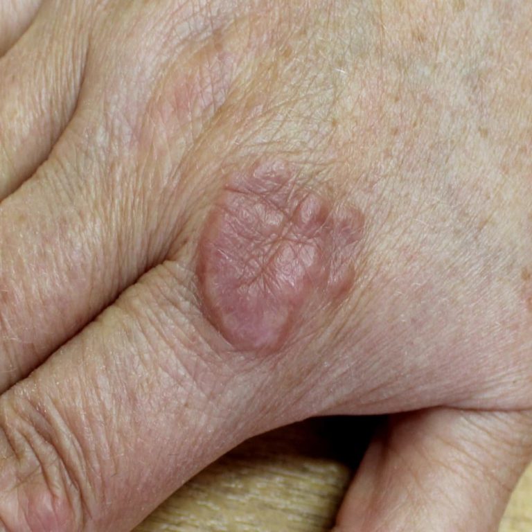 Granuloma annulare