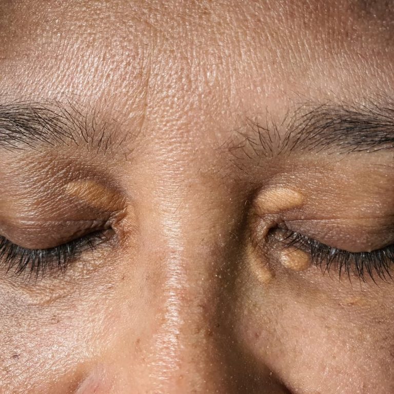 Xanthelasma