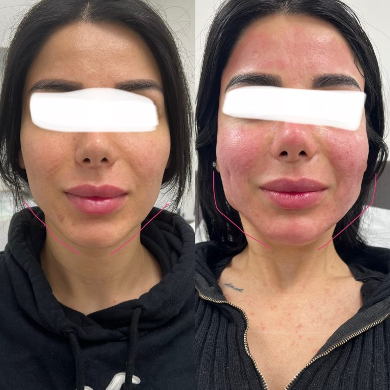 After / Before (Jawline Slimming & Skin Pen)