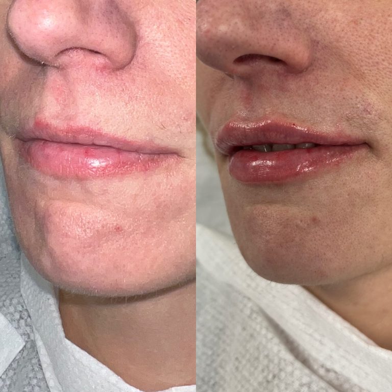 Lip Filler