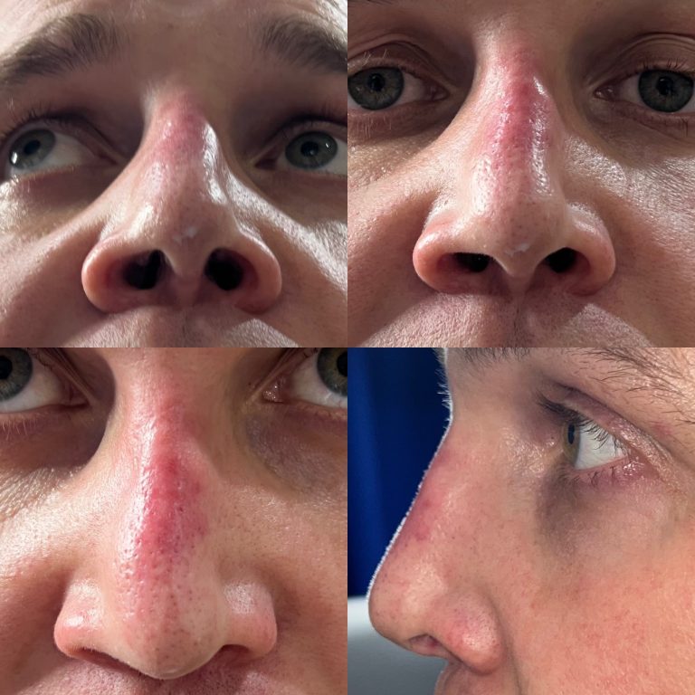 Non Surgical Rhynoplasty
