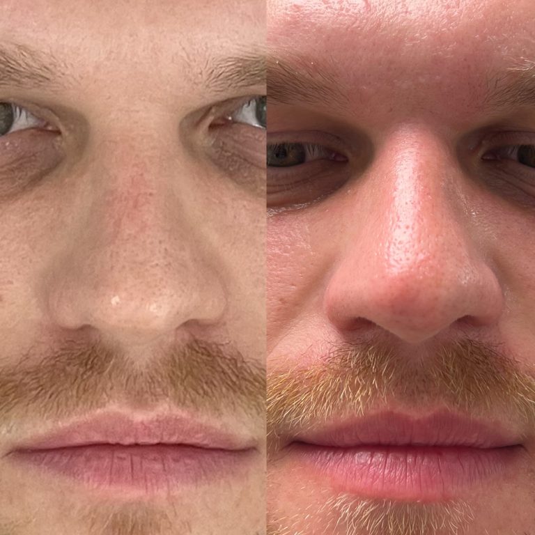 Hydrafacial