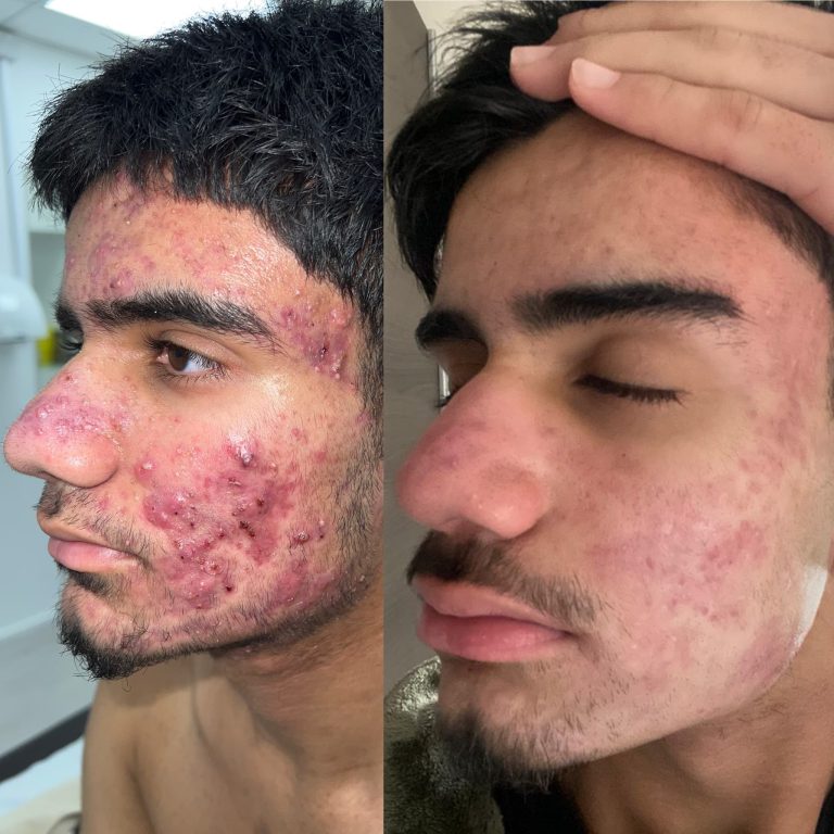 Acne Treatment