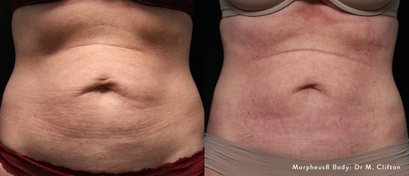 Morpheus8-Body-Before-After-1300x561