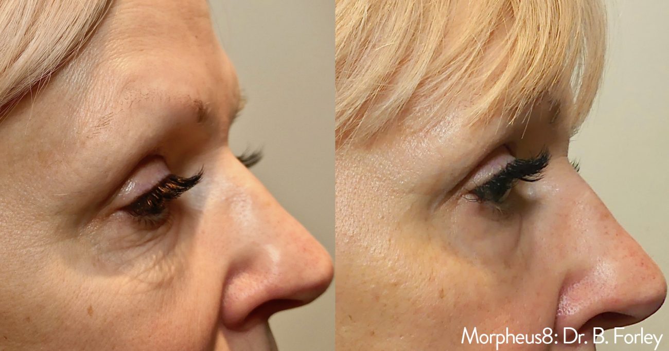 Morpheus8_BeforeAfter-2-1300x683