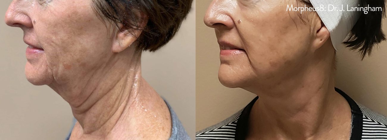 Morpheus8_BeforeAfter-5-1300x472