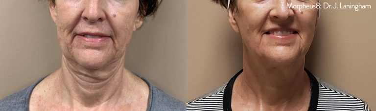 Morpheus8_BeforeAfter-6-768x227