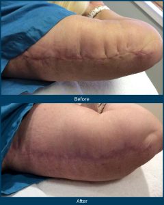 BA-SkinPen-Microneedling Outcomes in Early Postsurgical Scars_Arm