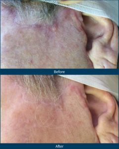BA-SP-Microneedling Outcomes in Early Postsurgical Scars_Facelift2