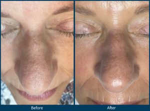 BA-SkinPen-TheLuxeEstie_Set10_Age61_Treatments1