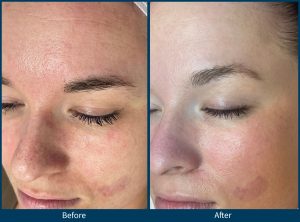 BA-SkinPen-TheLuxeEstie_Set6_Age34_Treatments2