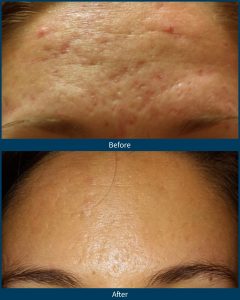 BA acne scars 1