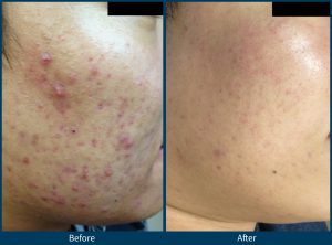 BA acne scars 2