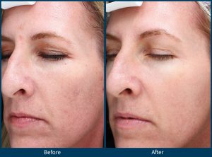 BA acne scars 3