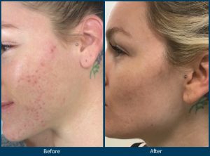 BA acne scars 4