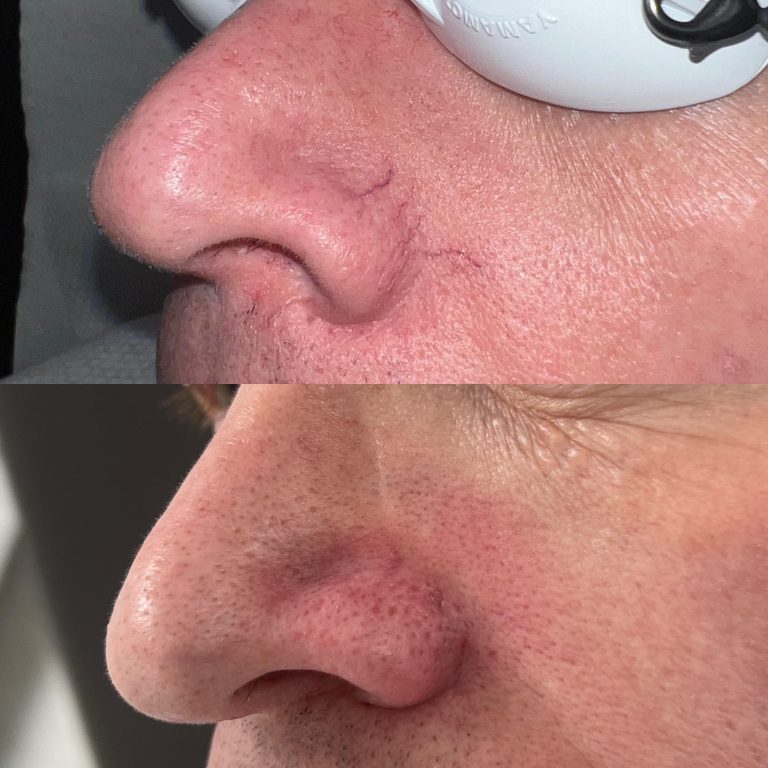 Thread Vein Removal