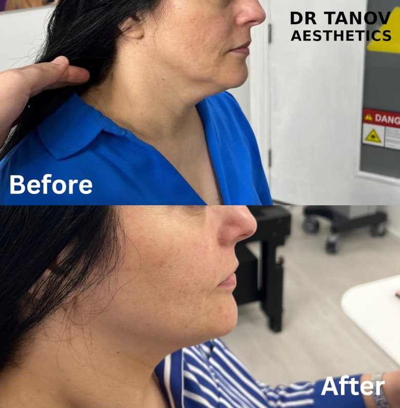 Morpheus 8 Treatment