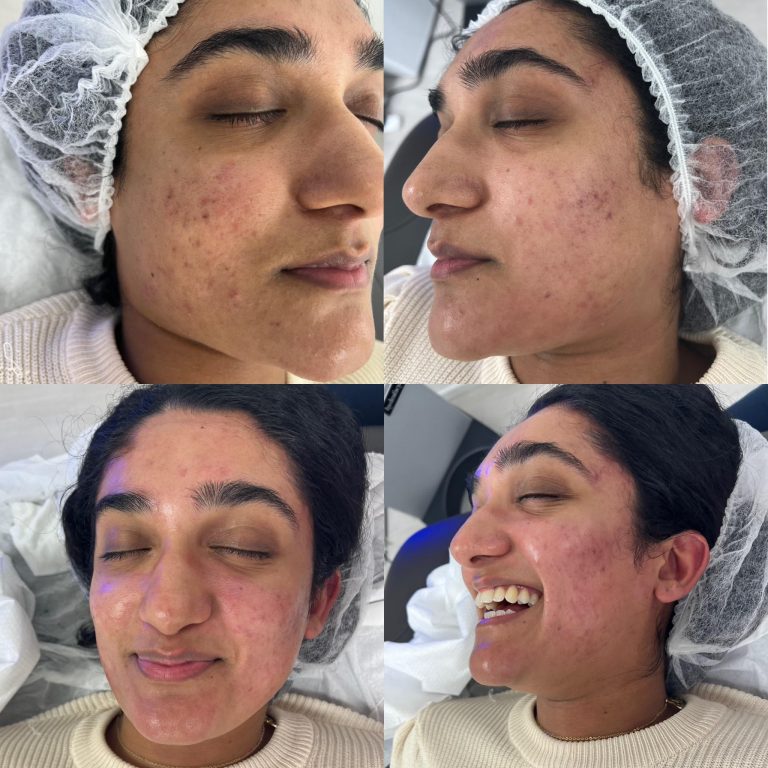Hydrafacial Treatment