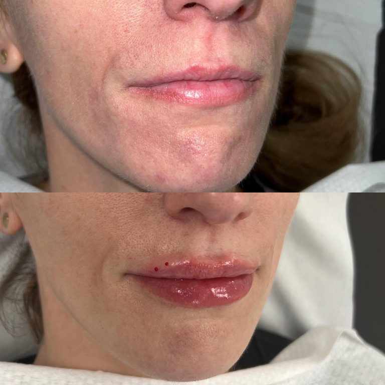 Lip Filler Treatment