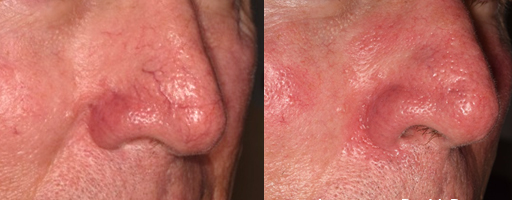 lumecca-before-after-dr-v-ross-preview-1 (1)