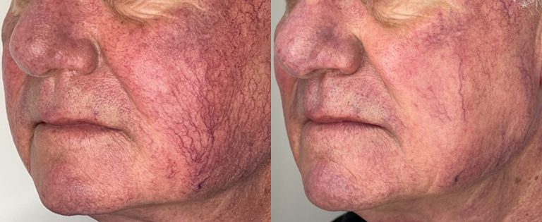 lumecca-before-after-dr-v-ross-preview-1
