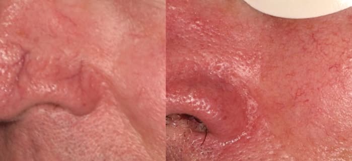 lumecca-before-after-dr-v-ross-preview-11