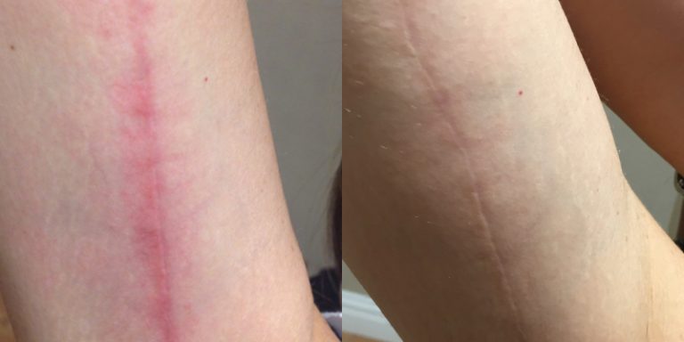 lumecca-before-after-lauren-abramowitz-rpa-c-park-avenue-skin-solutions-preview-1