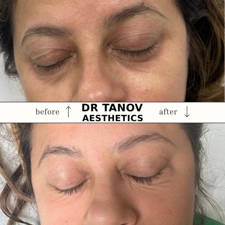 Non-surgical CO2 Blepharoplasty