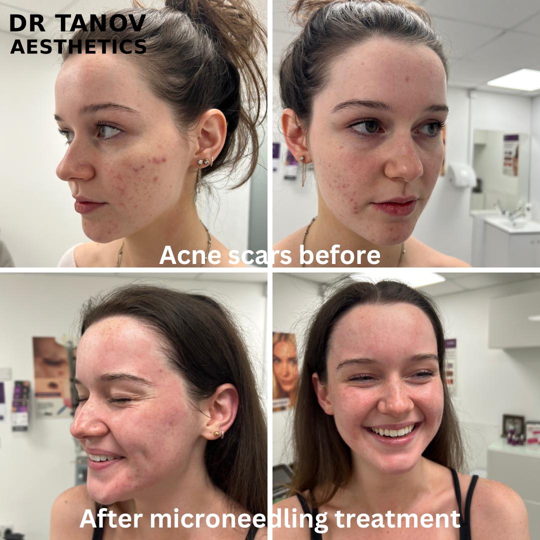 Before and after — SkinPen, Dr Tanov Eye & Aesthetics