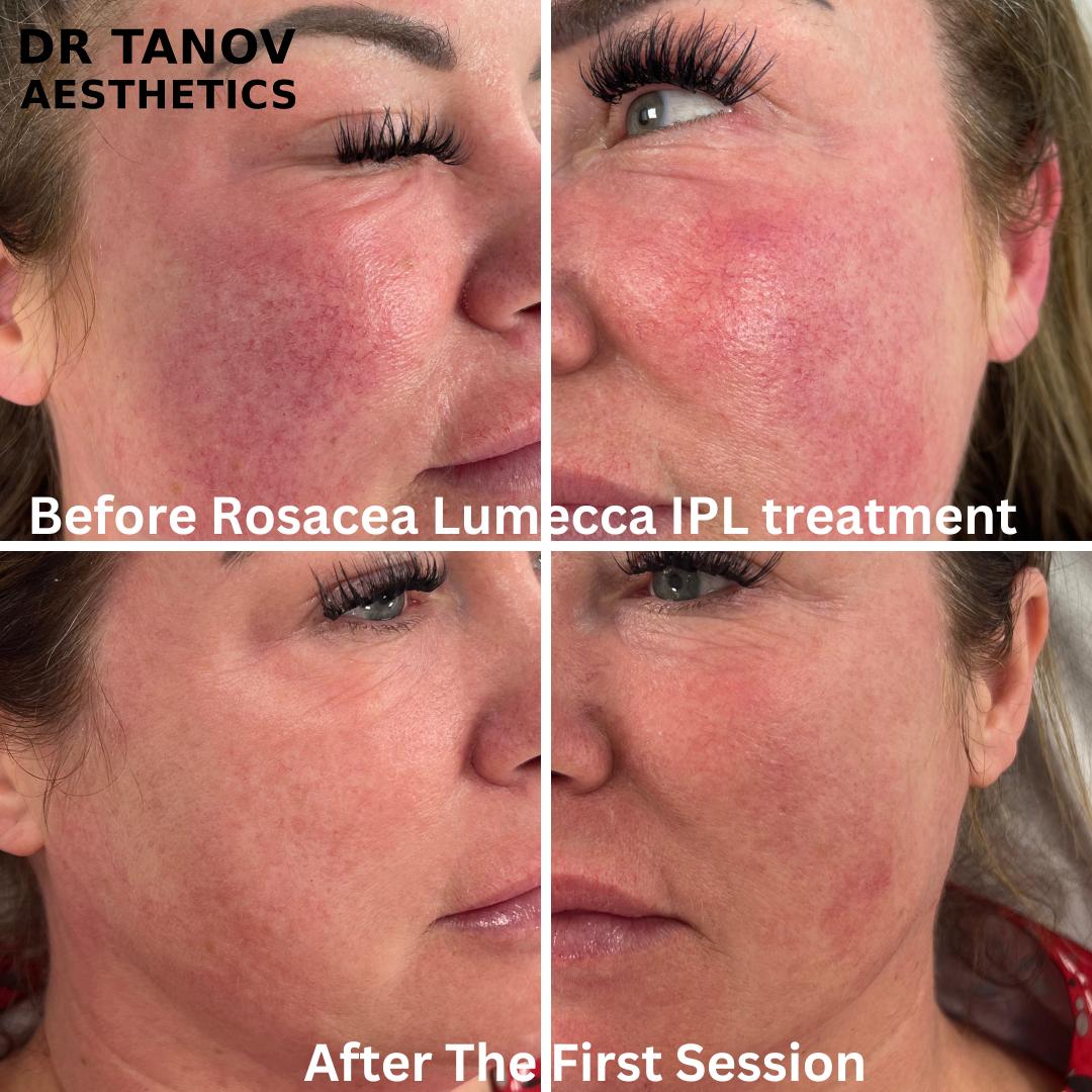 IPL Lumeca for Thread Veins