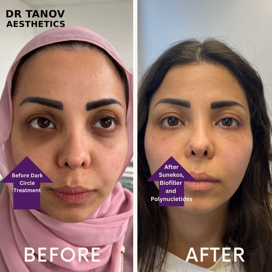 Bio Filler & Mesotherapy