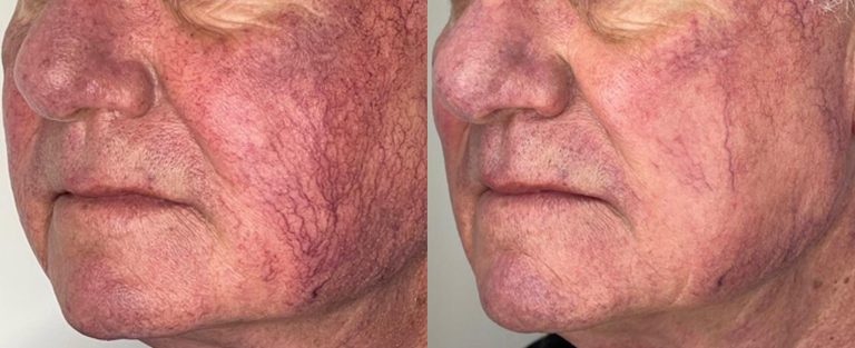 Thread Vein Removal with IPL Lumeca