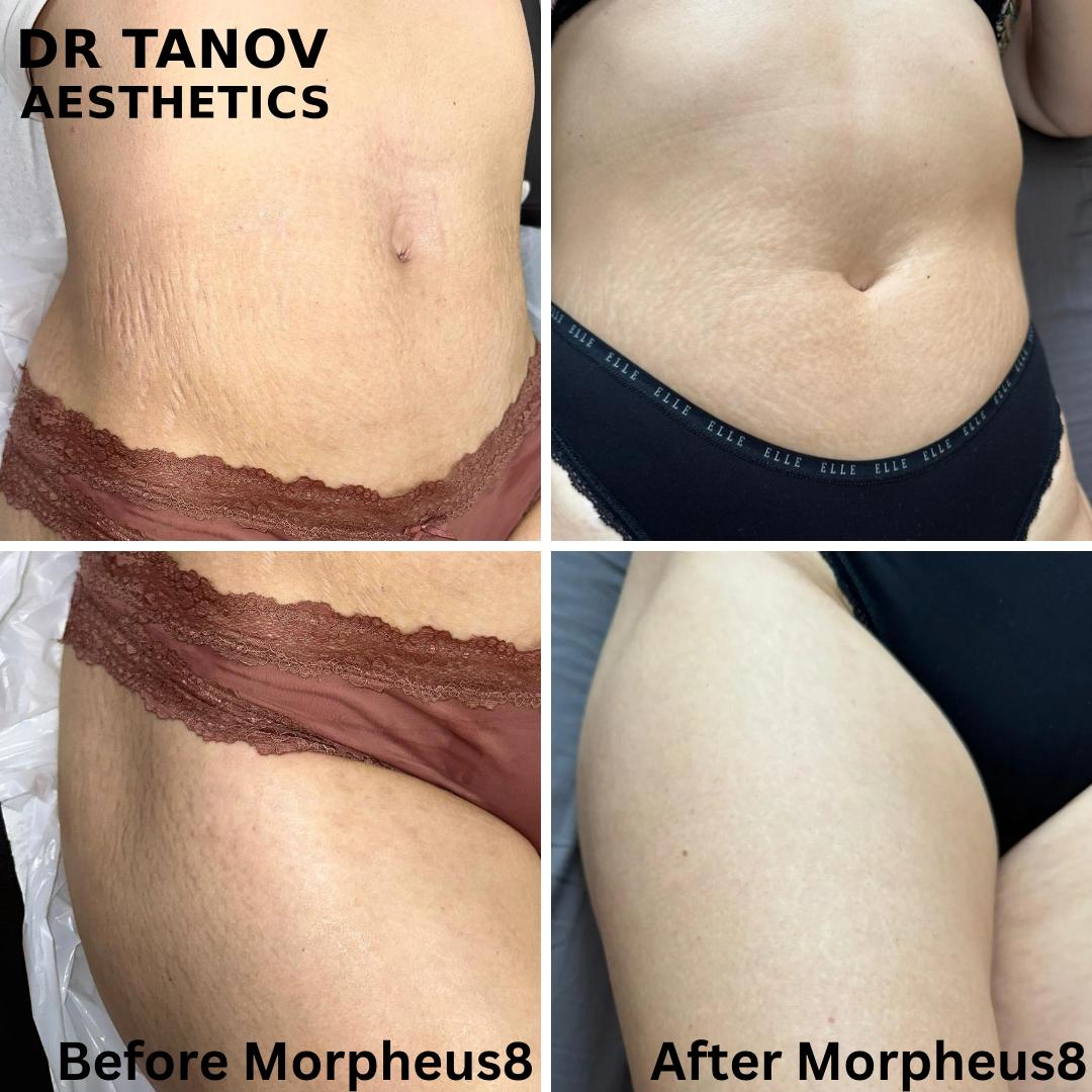 Morpheus 8 for Stretch Marks