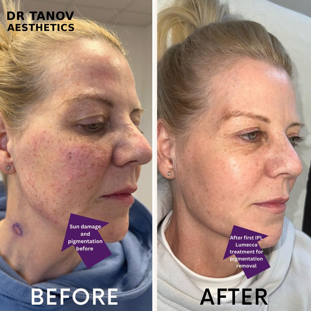 IPL Lumeca for Pigmentation Removal