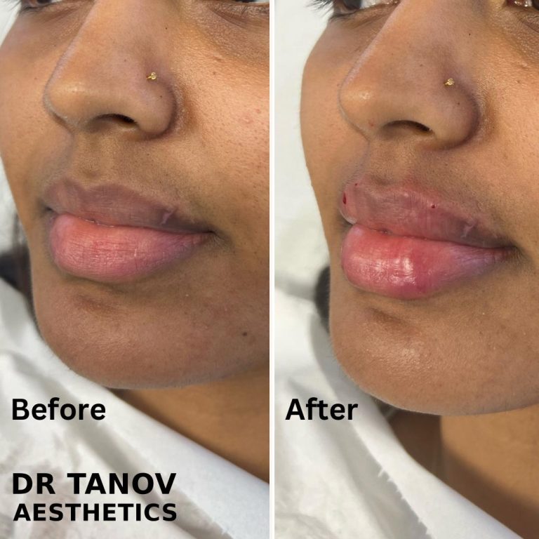 Lip Filler