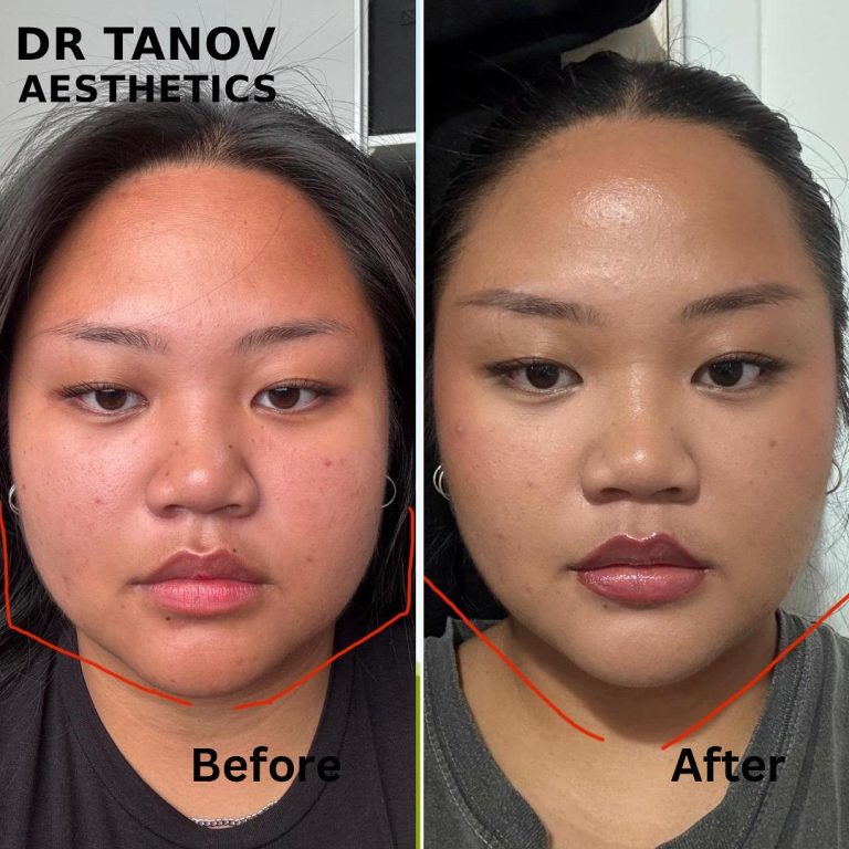 Jawline Slimming