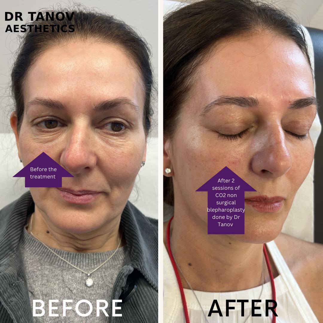 Non-surgical CO2 Blepharoplasty