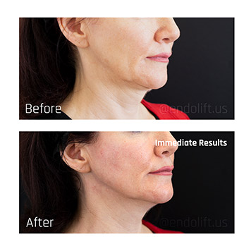 amanda-jawline-immediate-results